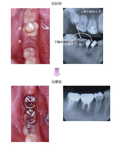 歯の移植について